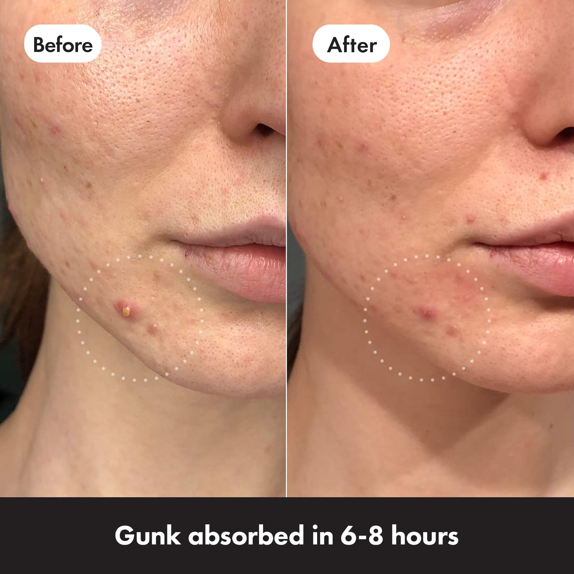 Hero Cosmetics - Mighty Patch Original Spot Patches (36 Count) 6