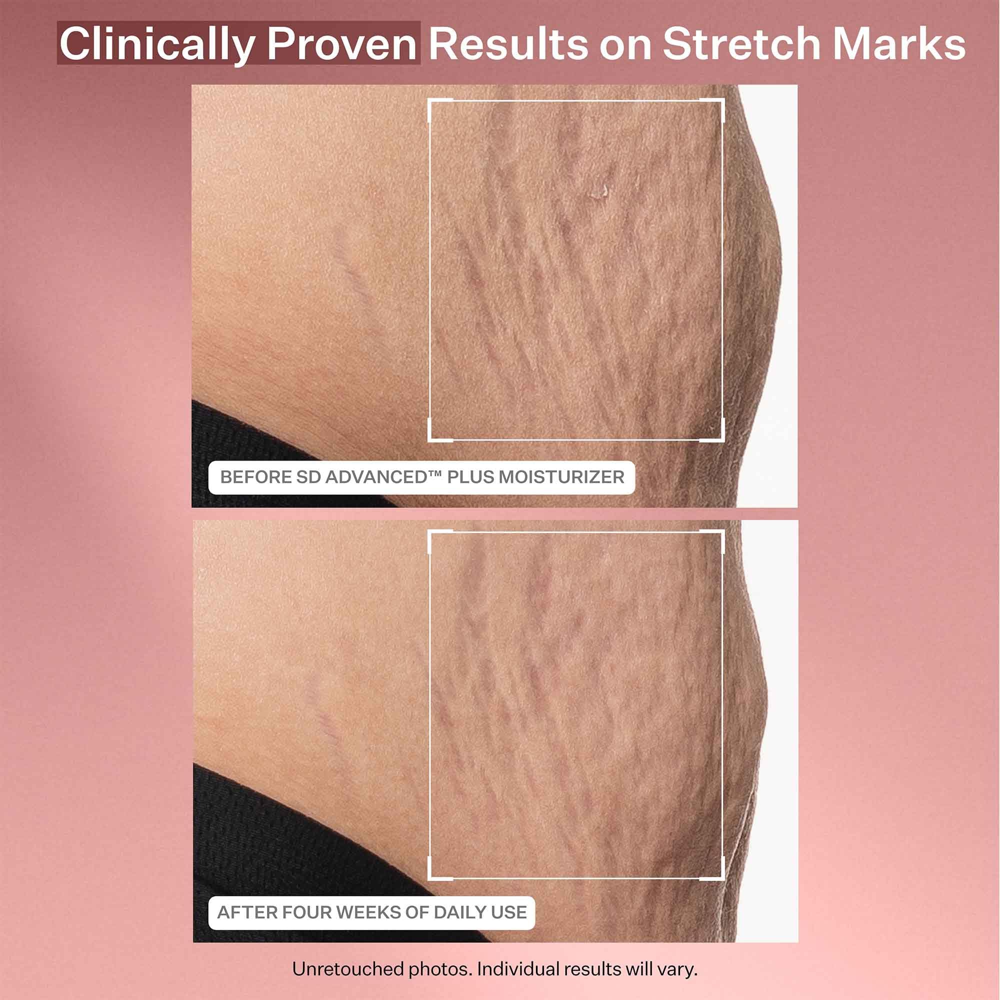 StriVectin SD Advanced Plus Intensive Moisturizer for Wrinkles & Stretchmarks | 120 ml | Unisex Adult 4