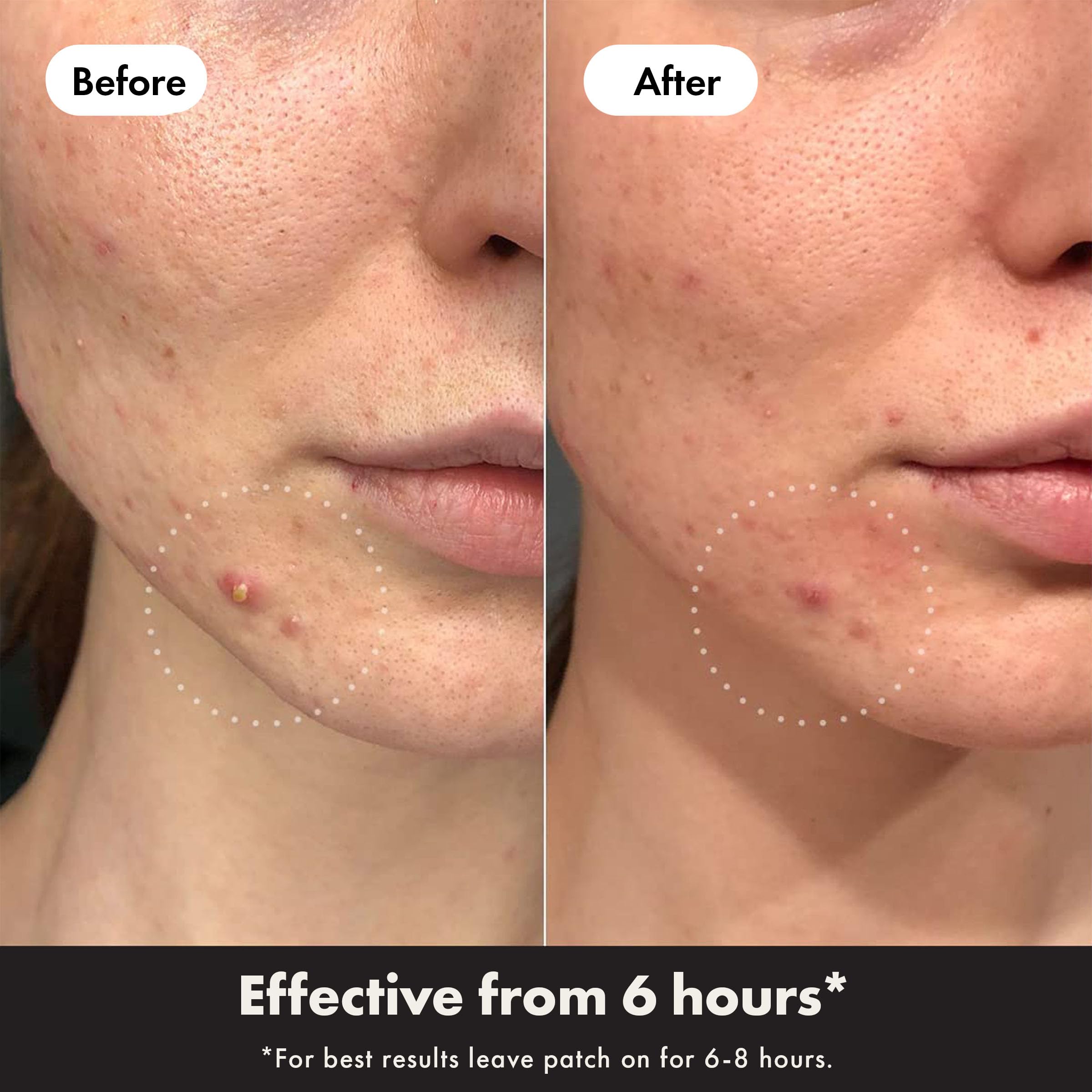 Hero Cosmetics - Mighty Patch Day + Night Hydrocolloid Acne Patches (24 Count) 9